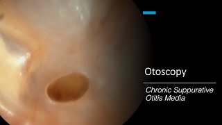 Chronic Suppurative Otitis Media Otoscopy [upl. by Muryh]