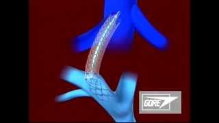 Endoprosthesis  Transjugular Intrahepatic Portosystemic Shunt TIPS [upl. by Llorrac]