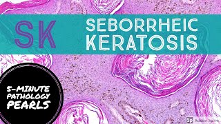 Seborrheic Keratosis 5Minute Pathology Pearls [upl. by Scrogan]