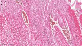 Myocardial Infarction  Histopathology [upl. by Thury361]