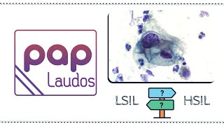 PapLaudos 03  Lesão intraepitelial escamosa de baixo grau LSIL x alto grau HSIL [upl. by Thursby]