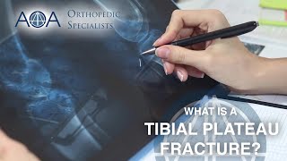 AOA Orthopedic Specialists  Tibial Plateau Fracture [upl. by Wystand]