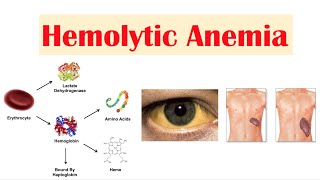 Hemolytic Anemia [upl. by Anilos]