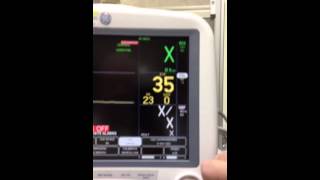 Capnography EtCO2 Monitoring [upl. by Sinnej]