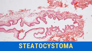 Steatocystoma  Pathology mini tutorial [upl. by Blaine]