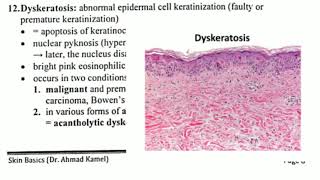 Dyskeratosis congenita Medical Condition [upl. by Imojean600]