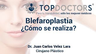 Blefaroplastia ¿Cómo se realiza el levantamiento de párpados [upl. by Nonnair]