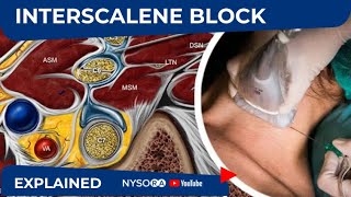 NYSORA Regional Anesthesia Interscalene Block [upl. by Aztinad]