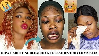 STORYTIME HOW CAROTONE BLEACHING CREAM DESTROYED MY SKIN😭😭 [upl. by Neerac596]