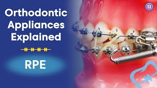 Orthodontic Appliances Explained  RPE [upl. by Olivie302]