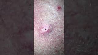 Intense Cyst Explosion PT2 [upl. by Latton889]