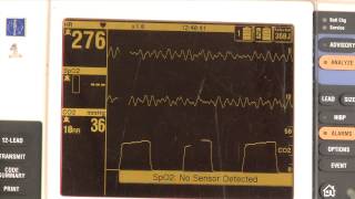 Waveform capnography demonstration [upl. by Retniw]