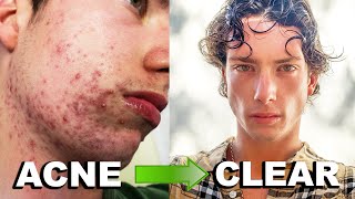 MY ACCUTANE JOURNEY  Clearing 6 Years of Acne Big Acne Transformation [upl. by Normak928]