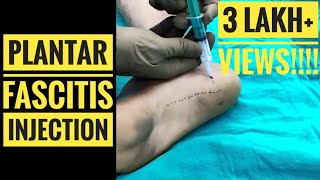 Plantar Fascitis Injection Technique [upl. by Repard975]