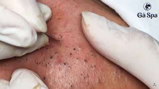 Best Blackhead Removal Ever 55min  Facial Acne Treatment  Gà Spa [upl. by Ymmaj47]