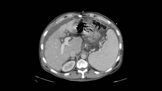 Transjugular Intrahepatic Portosystemic Shunt TIPS [upl. by Plate227]