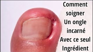 Comment soigner un ongle incarné naturellement [upl. by Rie]