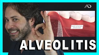 🌡️ALVEOLITIS SECA CAUSAS Y SOLUCIONES🥵Infeccion después de SACAR una MUELA [upl. by Aidualk]