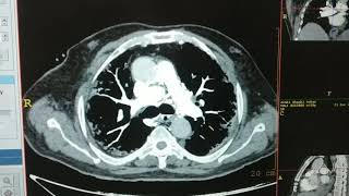 CT PULMONARY ANGIOGRAPHY [upl. by Aicnetroh]