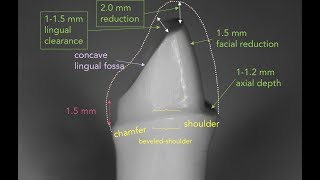 Anterior PFM Preparation  Dr Richard Stevenson [upl. by Ynohtnaleahcim]