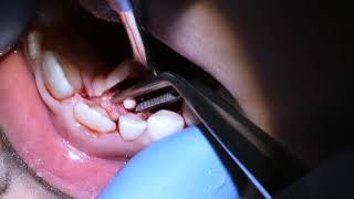 Compound Odontoma removal [upl. by Amsed]