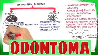 Odontoma  Types Clinical features Histopathological Features amp Treatment [upl. by Thomasina]