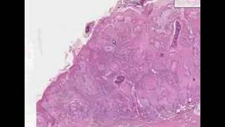 Histopathology Skin Squamous cell carcinoma [upl. by Kira]