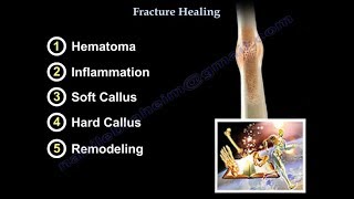 Fracture Healing  Everything You Need To Know  Dr Nabil Ebraheim [upl. by Nomyaw]