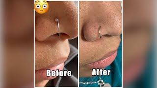 Get rid of that nose piercing bump FOR GOOD Find out what really works Easiest method [upl. by Deraj]