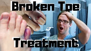 Broken Toe Fracture Treatment SHOULD I See A Doctor [upl. by Harden]