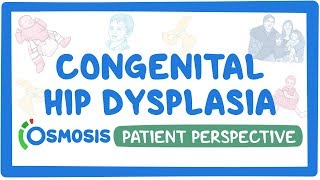 Patient Perspective Congenital hip dysplasia [upl. by Eiliab]