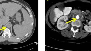 Introduction to Radiology Computed Tomography [upl. by Clarhe]