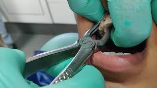 Painless and Easiest method for tooth extraction [upl. by Noreen]