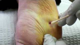 Surgical Plantar Wart Removal [upl. by Merow497]