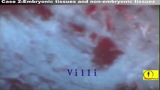 Abortion MTP Video MTP Procedure [upl. by Mayne]