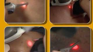 Laser Hair Removal video by Cynosure [upl. by Lolita862]