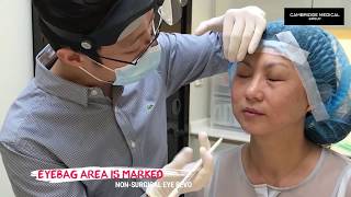 NonSurgical Eyebag Removal at Cambridge Medical [upl. by Rawna987]