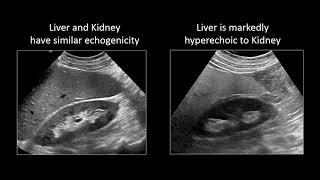 GI Imaging  Hepatic Steatosis and Cirrhosis [upl. by Sherlocke]