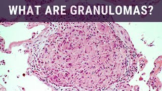 What are Granulomas  Pathology mini tutorial [upl. by Aneri960]