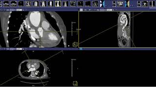 CT Scan Pulmonary Angio PTE protocol [upl. by Aramac605]