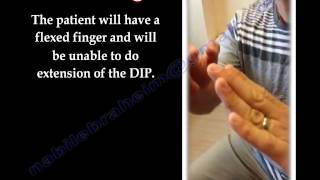 Mallet Finger  Everything You Need To Know  Dr Nabil Ebraheim [upl. by Nonie]