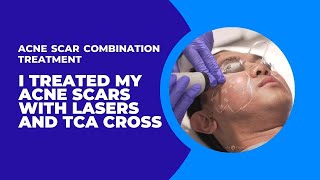 I TREATED MY ACNE SCARS WITH LASERS AND TCA CROSS  ACNE SCAR COMBINATION TREATMENT  Dr Jason Emer [upl. by Mannuela]