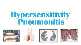 Hypersensitivity Pneumonitis  Hot Tub Lung Farmer’s Lung Bird Fancier’s Lung Bagassosis [upl. by Nollek158]