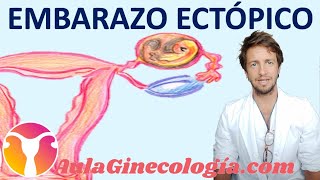 EMBARAZO ECTÓPICO CAUSAS SÍNTOMAS DIAGNÓSTICO BHCG ECOGRAFÍA  Ginecología y Obstetricia [upl. by Cerveny35]