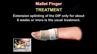 Mallet Finger Treatment  Everything You Need To Know  Dr Nabil Ebraheim [upl. by Hubsher]