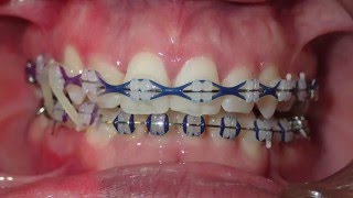 Orthodontic Transformation from Start to Finish [upl. by Enorahs]