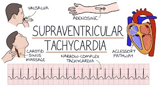 Understanding Supraventricular Tachycardia SVT [upl. by Illoh]