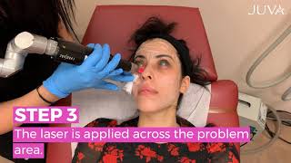 Can Lasers Address My Dark Circles [upl. by Hazem]