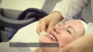 Laser Skin Rejuvenation with Cynosure’s Multiplex Affirm System at The Laser and Skin Clinic [upl. by Notnad]