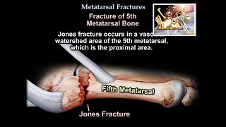 Metatarsal Fractures  Everything You Need To Know  Dr Nabil Ebraheim [upl. by Martino777]